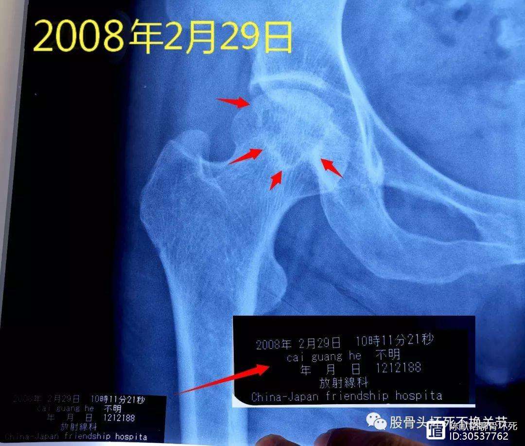 河池人工骨头医保报销多少(人工骨头医保报销多少比例)